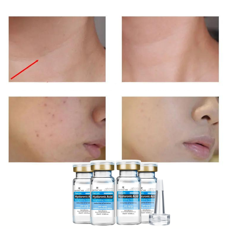 sérum, acne, cuidados com a pele, skincare, anti sinais, vitamina C, cosmético, dermocosmetico, pele bonita, estética facial, rugas, pé de galinha, linha de expressão, ácido hialurônico